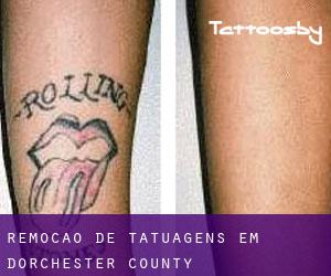 Remoção de tatuagens em Dorchester County