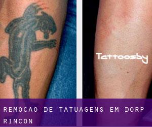 Remoção de tatuagens em Dorp Rincón