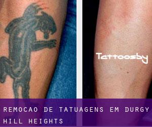 Remoção de tatuagens em Durgy Hill Heights