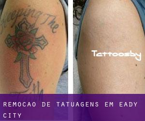 Remoção de tatuagens em Eady City