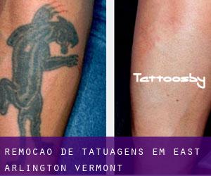 Remoção de tatuagens em East Arlington (Vermont)