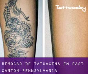 Remoção de tatuagens em East Canton (Pennsylvania)
