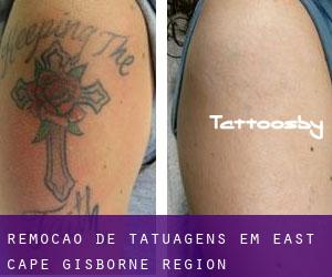 Remoção de tatuagens em East Cape (Gisborne Region)