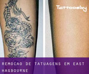 Remoção de tatuagens em East Hagbourne