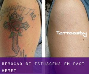 Remoção de tatuagens em East Hemet