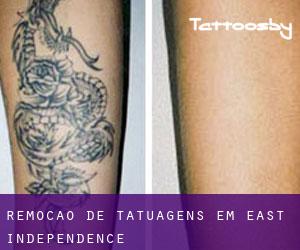 Remoção de tatuagens em East Independence