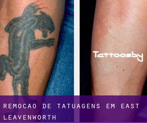 Remoção de tatuagens em East Leavenworth