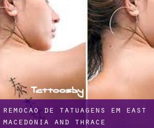 Remoção de tatuagens em East Macedonia and Thrace