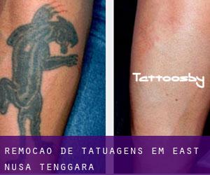 Remoção de tatuagens em East Nusa Tenggara