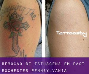 Remoção de tatuagens em East Rochester (Pennsylvania)