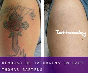 Remoção de tatuagens em East Thomas Gardens