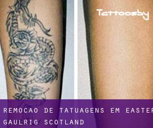 Remoção de tatuagens em Easter Gaulrig (Scotland)