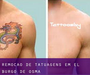 Remoção de tatuagens em El Burgo de Osma