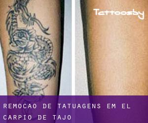 Remoção de tatuagens em El Carpio de Tajo