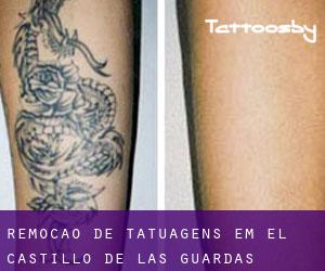 Remoção de tatuagens em El Castillo de las Guardas