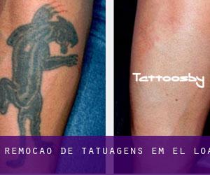 Remoção de tatuagens em El Loa