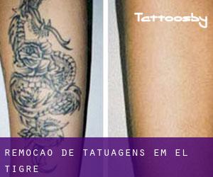 Remoção de tatuagens em El Tigre