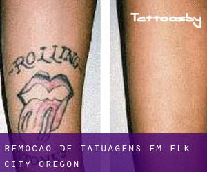 Remoção de tatuagens em Elk City (Oregon)