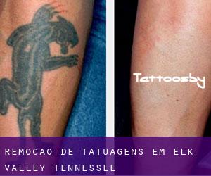 Remoção de tatuagens em Elk Valley (Tennessee)