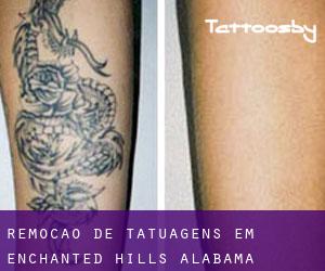 Remoção de tatuagens em Enchanted Hills (Alabama)