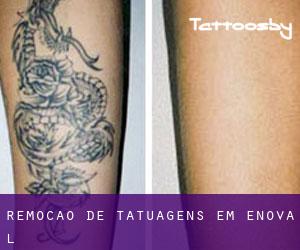 Remoção de tatuagens em Ènova (l')