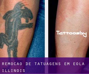 Remoção de tatuagens em Eola (Illinois)
