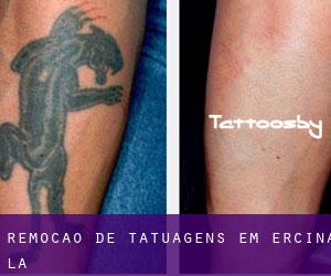 Remoção de tatuagens em Ercina (La)