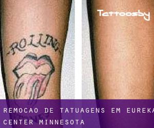 Remoção de tatuagens em Eureka Center (Minnesota)