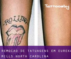 Remoção de tatuagens em Eureka Mills (North Carolina)