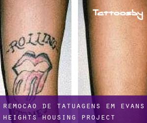 Remoção de tatuagens em Evans Heights Housing Project