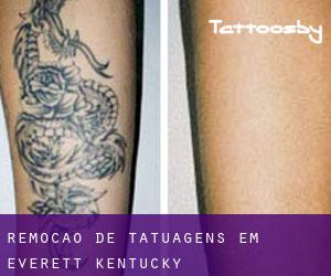 Remoção de tatuagens em Everett (Kentucky)