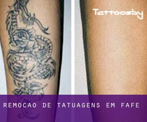 Remoção de tatuagens em Fafe