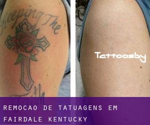 Remoção de tatuagens em Fairdale (Kentucky)