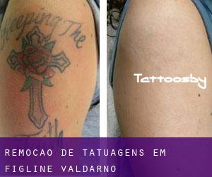 Remoção de tatuagens em Figline Valdarno