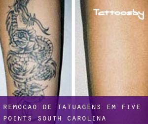 Remoção de tatuagens em Five Points (South Carolina)