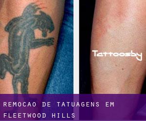 Remoção de tatuagens em Fleetwood Hills