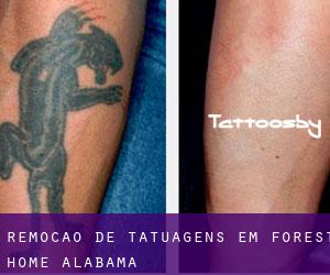 Remoção de tatuagens em Forest Home (Alabama)