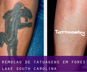 Remoção de tatuagens em Forest Lake (South Carolina)