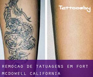 Remoção de tatuagens em Fort McDowell (California)