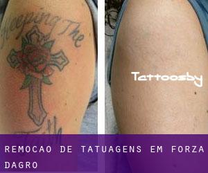 Remoção de tatuagens em Forza d'Agrò