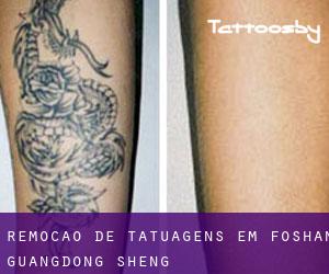Remoção de tatuagens em Foshan (Guangdong Sheng)