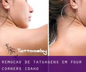 Remoção de tatuagens em Four Corners (Idaho)