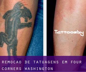 Remoção de tatuagens em Four Corners (Washington)