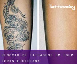 Remoção de tatuagens em Four Forks (Louisiana)
