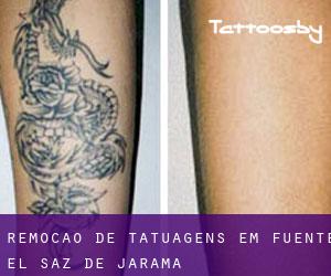 Remoção de tatuagens em Fuente el Saz de Jarama