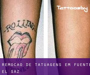 Remoção de tatuagens em Fuente el Saz