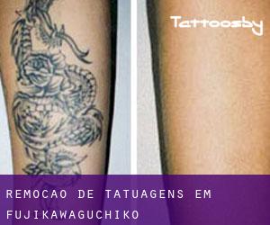 Remoção de tatuagens em Fujikawaguchiko
