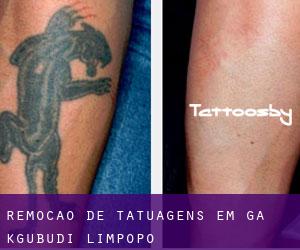 Remoção de tatuagens em Ga-Kgubudi (Limpopo)