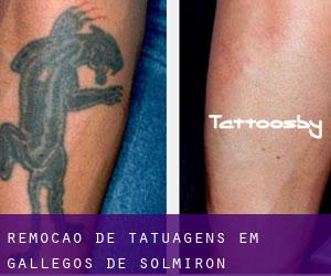 Remoção de tatuagens em Gallegos de Solmirón