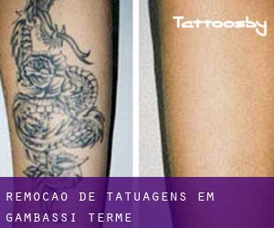 Remoção de tatuagens em Gambassi Terme